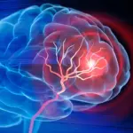 Injectable Biomaterial Offers New Hope for Brain Tissue Repair After Ischemic Stroke